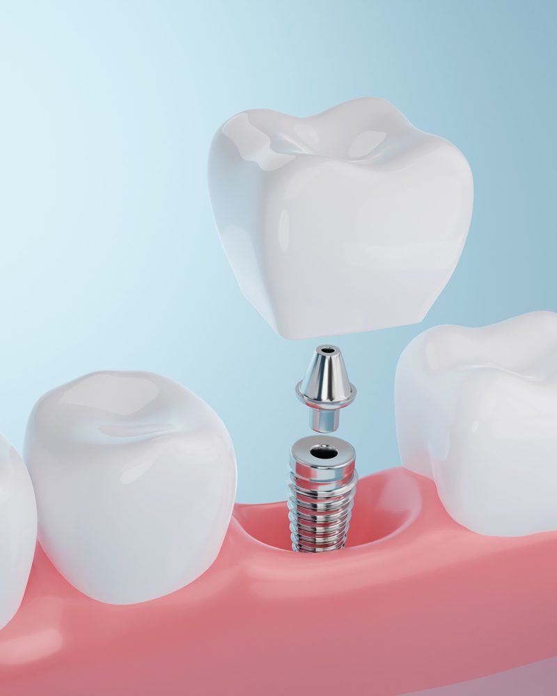 Affordable Dental Implants - Bradenton, FL