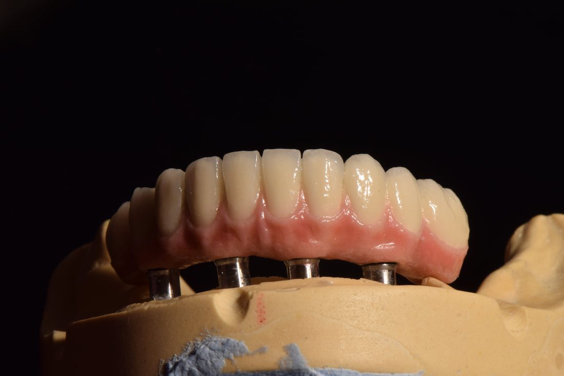all on 4 - bradenton dental implants