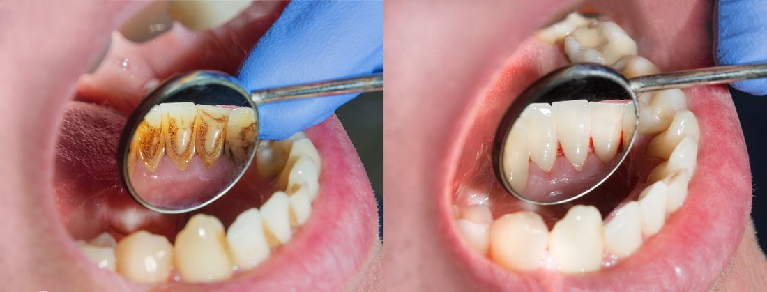 periodontal disease - bradenton, fl